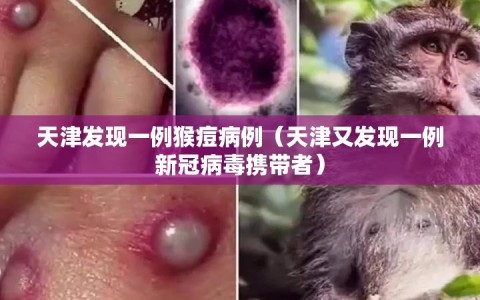 天津发现一例猴痘病例（天津又发现一例新冠病毒携带者）
